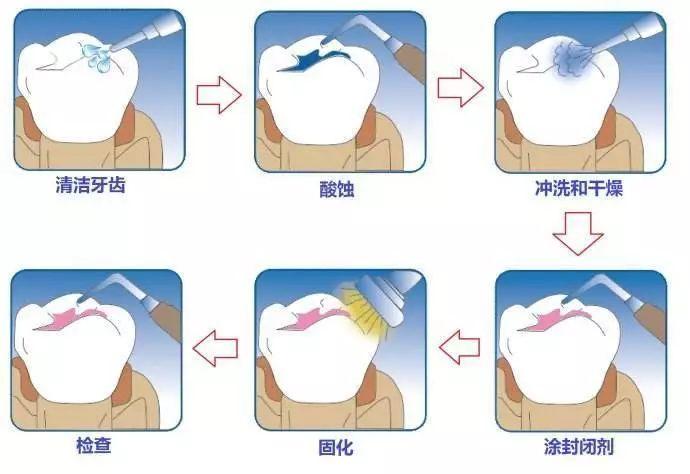 窩溝封閉